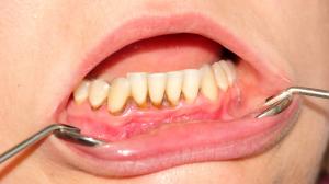 Paradentóza: môže viesť k strate zubov