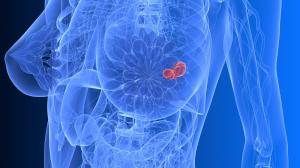 Rakovina prsníka: na príčine môžu byť aj bielkoviny živočíšneho pôvodu